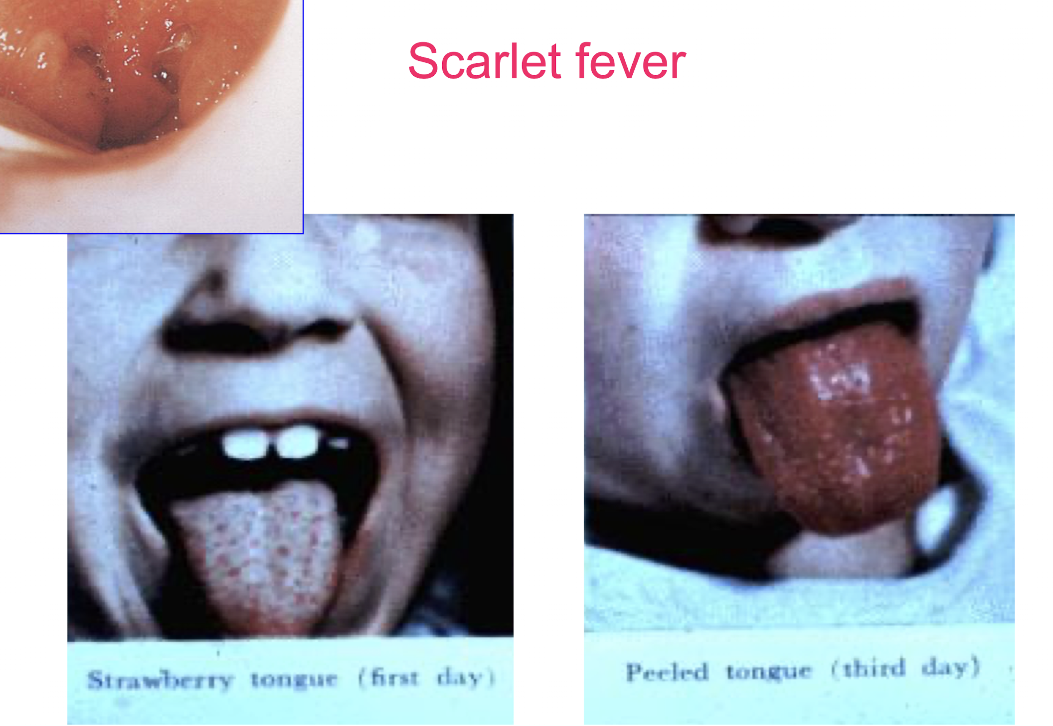 <p><strong>Scarlet fever is characterised by a<mark data-color="red" style="background-color: red; color: inherit;"> bright red rash, often accompanied by a sore throat, fever, and a coated tongue </mark></strong>“Strawberry tongue” → develops into a ‘peeled tongue;”</p><ul><li><p>The rash typically appears between 12 to 48 hours after the onset of other symptoms. </p></li></ul><ul><li><p><strong>Circumoral pallor</strong> is present, with a pale area around the mouth, while the rest of the body exhibits a<strong> fine, sandpaper-like rash. </strong></p><img src="https://knowt-user-attachments.s3.amazonaws.com/8cef57b0-2ac0-488b-8e6c-3a892d08fa3f.png" data-width="25%" data-align="center"></li><li><p>Symptoms may also include headache and abdominal pain. </p></li></ul><img src="https://knowt-user-attachments.s3.amazonaws.com/56a28241-75f8-4e4e-b44a-8eb2bed9f7fb.png" data-width="25%" data-align="center" alt=""><p></p>