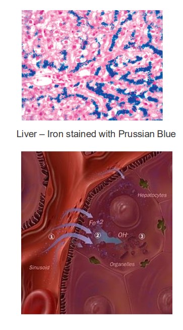 <p>EXCESS:</p><p>- haemochromatosis (hereditary, genetic disease)</p><p>- iron builds up: deposits in liver, heart and joins</p><p>- Can lead to cirrhosis (scarring) of liver</p><p>.</p><p>TREATMENT:</p><p>- give blood regularly</p><p>- vegetarian diet (foods less dense in iron)</p><p>.</p><p>- basically what happens is that if u have the disease, you lose the signal that tells the endothelial cells to stop uptaking iron when iron is sufficiently high. We'll have an inappropriate amount of iron being transported into our bodies. And this is a problem because if we're having this buildup of iron, obviously we'll try and do things that sequester iron, maybe make a bit more ferritin, try make sure it doesnt react with H2O2 and produce superoxide molecules. But there will be a limit to how much we can do if someone keeps eating a lot of iron containing foods, and so we can end up with deposits in the liver. this iron produces reactive oxygen species which damages tissues</p>