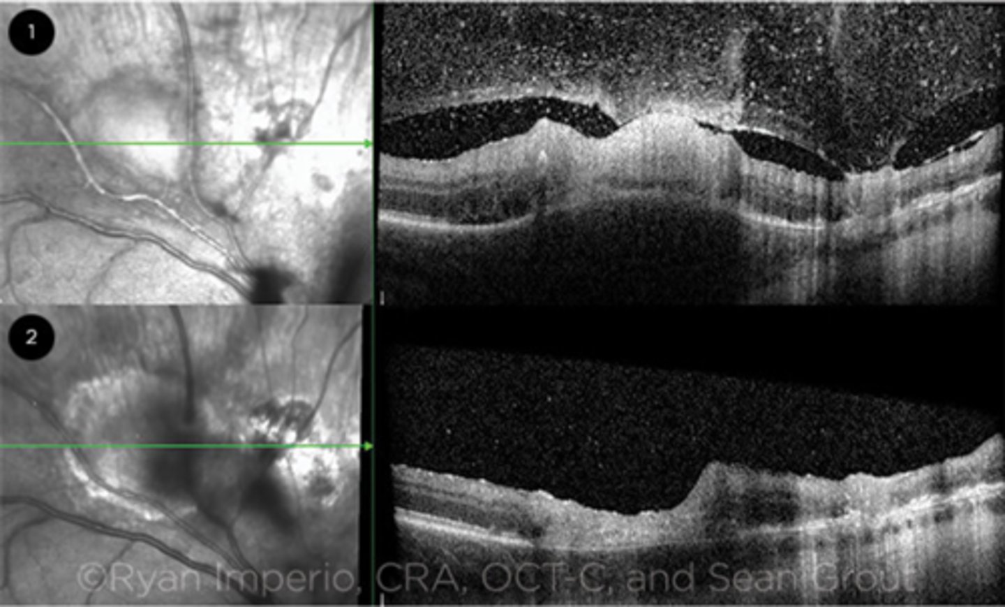 <p>acute = retinitis = inflam, thickening of layers</p><p>acute = vitritis = dots and haze vitreous</p><p>chronic = necrotizing atrophy = scarring, thinning</p>