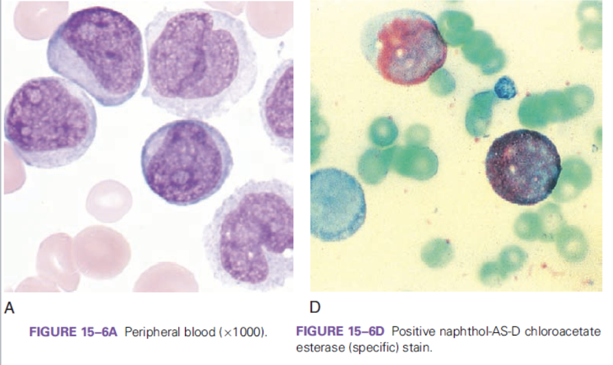 <p>which FAB classification is associated with the following information?</p><ul><li><p>very high WBC count</p></li><li><p>presence of monocytic cells (monoblasts and promonocytes)</p></li><li><p>positive naphthol-AS-D chloroacetate esterase (specific stain) </p></li></ul><p></p>