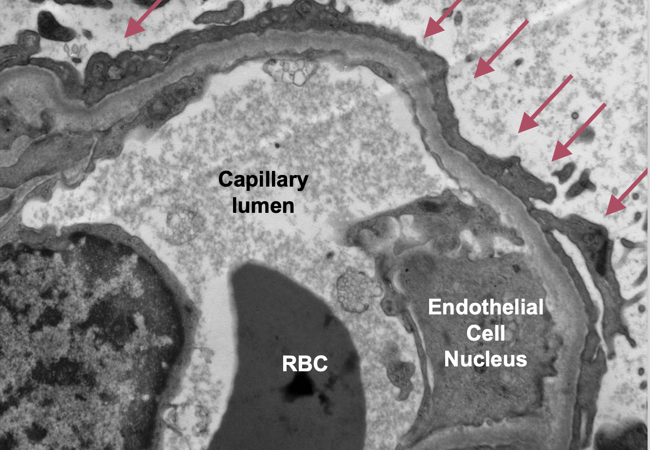<p>Podocyte foot process effacement</p>