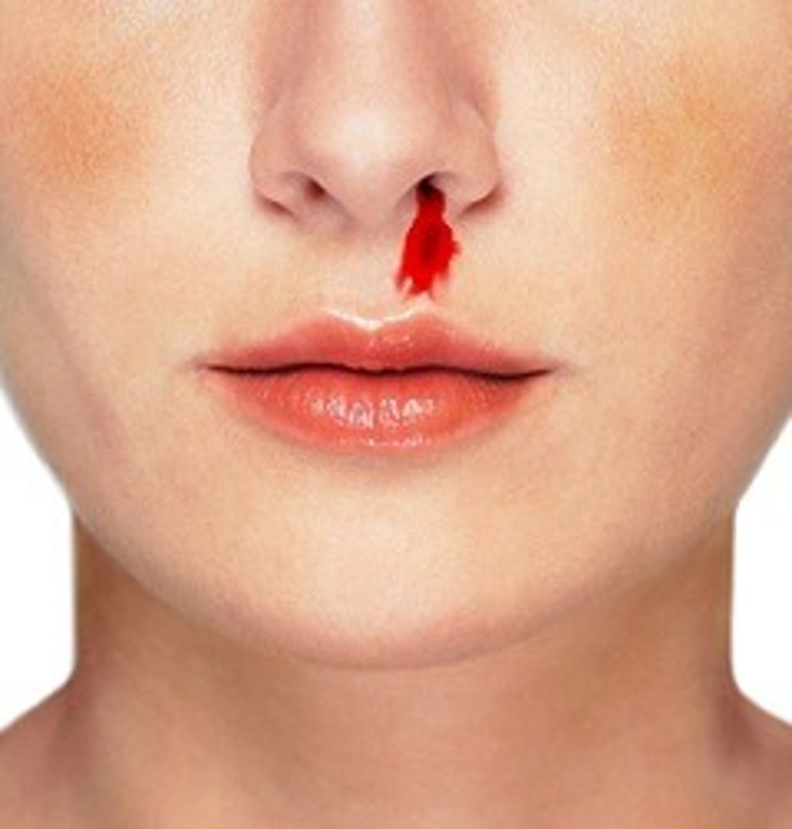 <p>Nosebleed, common due to the many capillaries within the nose</p>