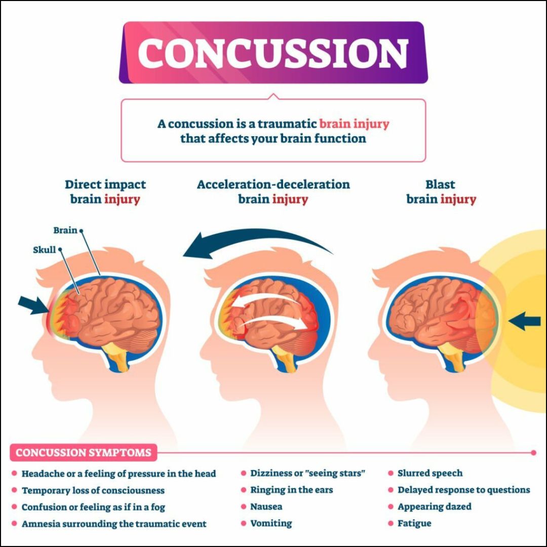 <p>→ <strong>TBI</strong> caused by a blow to the head with a blunt object or surface</p><ul><li><p>Usally little to no blood spilled or open wounding</p></li></ul><p></p><p><u>Whiplash process</u>:</p><ol><li><p><strong>Coup</strong> → brain comes into violent contact with the inside of the skull</p></li><li><p><strong>Contrecoup</strong> → brain then recoils in the opposite direction and (perhaps) smashes against the other side of the skull again</p></li></ol><p></p>