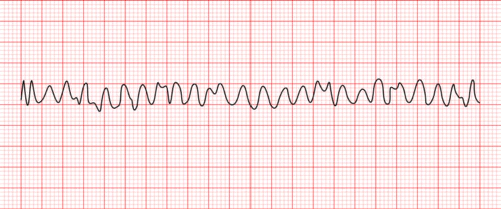 <p>what rhythm is shown in the ECG?</p>
