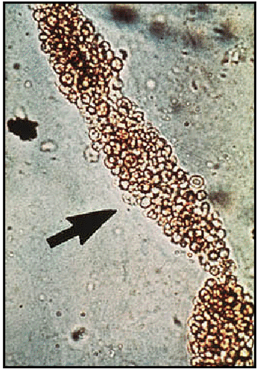 <p>Deep yellow to orange; contain RBCs</p>