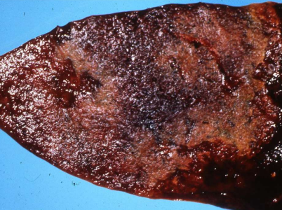 <p>What disease is this?</p>