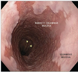 <p><strong>Barrett’s Esophagus: Diagnosis</strong></p><p>-EGD with ______</p><p>-Diagnostic criteria → ________ epithelium lines > 1 cm of distal esophagus. Biopsy reveals intestinal ___________ with ______ cells </p>