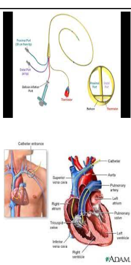 <p>pulmonary cathether<br>to diagnose right and left ventricular failure and pulmonary disorders<br>monitor effects of meds<br>monitor blood pressure</p>