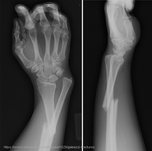 <p>Fracture of the distal/mid-radius with dislocation of the distal radioulnar joint.</p>
