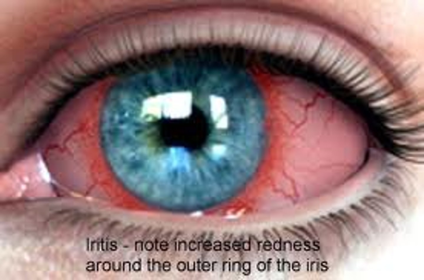 <p>inflammation of the iris, usually marked by pain,</p><p>pupil is often irregular</p>