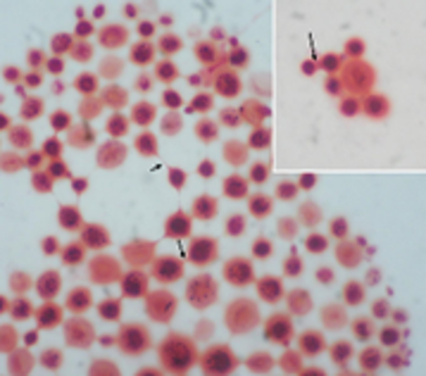 <p>· Signal disease for HIV or Kaposi sarcoma</p><p>· Tinkertoy structure</p>