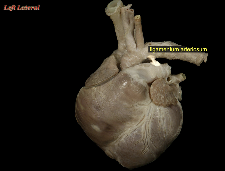 <p>Ligamentum arteriosum</p>