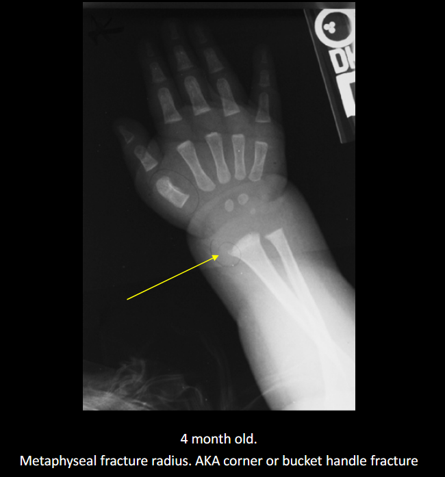 <p>Non-accidental injury/trauma; deliberate physical harm to a child.</p>