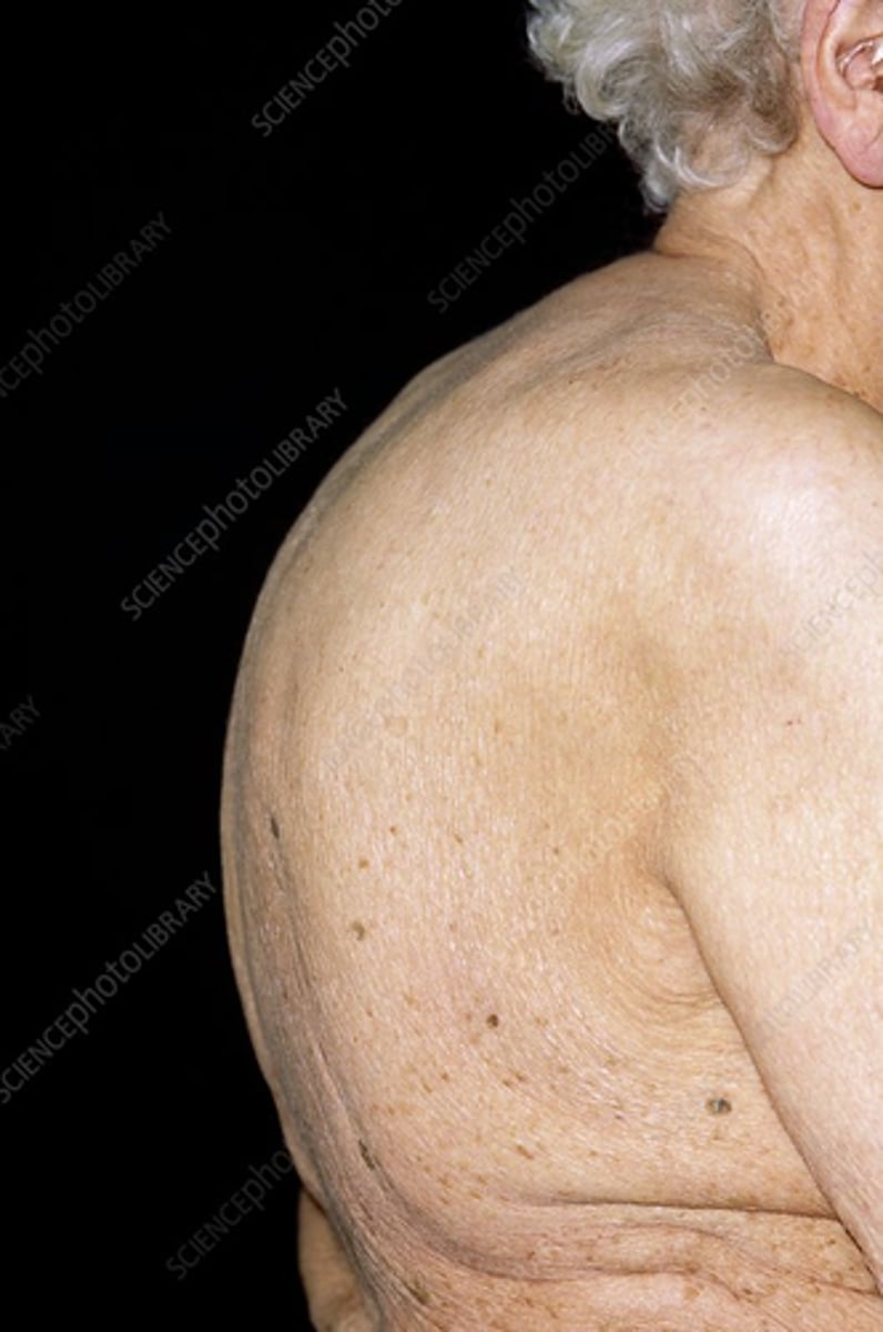 <p>what disease does this picture indicate?</p>
