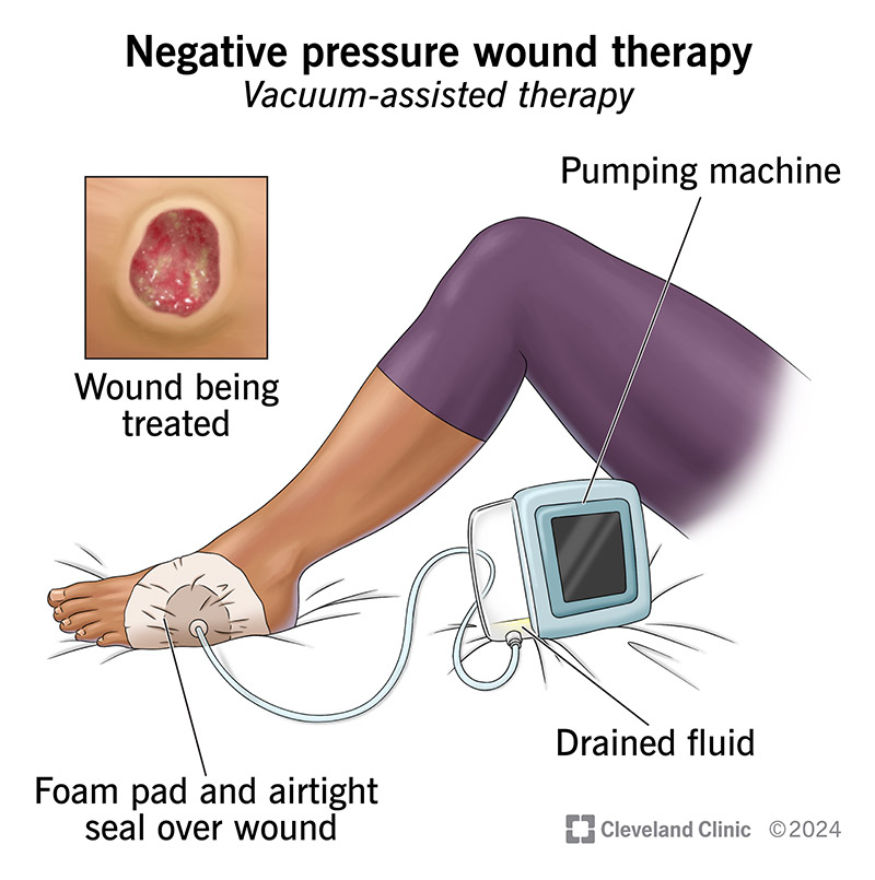 <p><span style="background-color: transparent; font-family: "Times New Roman", serif;"><strong><span>NEGATIVE PRESSURE WOUND THERAPY (Wound VAC)</span></strong></span></p><ul><li><p><span style="background-color: transparent; font-family: "Times New Roman", serif;"><span>Pulls wound edges together</span></span></p></li><li><p><span style="background-color: transparent; font-family: "Times New Roman", serif;"><span>Removes fluid and exudate</span></span></p></li><li><p><span style="background-color: transparent; font-family: "Times New Roman", serif;"><span>Reduces edema</span></span></p></li><li><p><span style="background-color: transparent; font-family: "Times New Roman", serif;"><span>Promotes angiogenesis (new blood vessels)</span></span></p></li><li><p><span style="background-color: transparent; font-family: "Times New Roman", serif;"><span>Increases granulation tissue formation</span></span></p></li></ul><p></p>