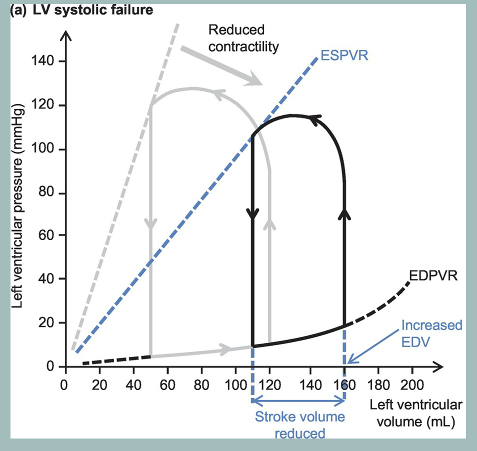 <ul><li><p><span>loss in systolic function decreases the slope of the ESPVR. This shifts the pressure volume loop to the right (black loop). The result is an increase in end-systolic volume as well as an increase in end-diastolic volume (compensatory increase in preload). The increase in end-diastolic volume is not as great as the increase in end-systolic volume therefore the stroke volume decreases as does the stroke work (area within the loop).</span></p></li><li><p><span>With acute systolic dysfunction, there is no change in the EDPVR; however, with chronic systolic dysfunction the EDPVR relationship would shift downward and to the right as the ventricle responds by remodeling (anatomical dilation) which increases ventricular compliance (not shown in the diagram on the right).</span></p></li></ul><p></p>