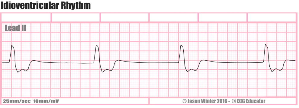 <p>All of the following are characteristics of idioventricular rhythm, EXCEPT:</p><p>a. Rhythm: regular</p><p>b. Rate: 60-100 bpm</p><p>c. P-waves: absent</p><p>d. QRS duration: > 0.12 sec</p>