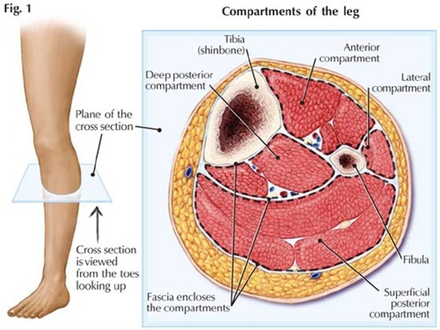 <p>increased pressure within space of lower leg causing compression in that compartment of the neural and vascular structures</p>