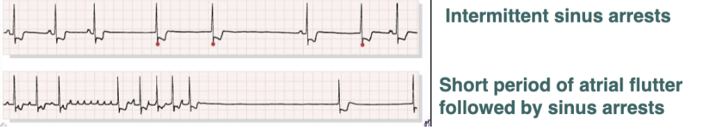 <p>__ is characterized by intermittent sinus arrests or short period of atrial flutter followed by sinus arrests. </p>