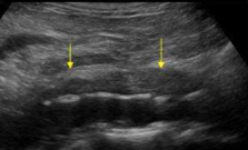 <p>What pathology is seen here in this sagittal image of the aorta?</p>