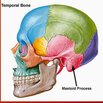 <p>air filled (honeycomb, strong and light). Upper front par - tympanic antrum is air filled and lined by prolongation of the mucous membrane of the tympanic cavity. Tympanic antrum bound above by the tegmen tympani which separates it from the middle fossa of the base of the skull; below by the mastoid process; laterally by the squama just below the temporal line and medially by the lateral semicircular canal of the internal ear which projects into its cavity. It opens in front into that portion of the tympanic cavity which is known as the attic or epitympanic recess. </p>