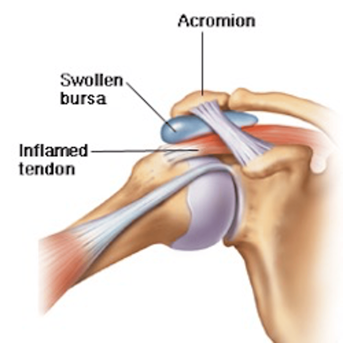 <p>- Overuse, repetitive activity</p><p>- Shoulder pain, worse with overhead lifting or reaching, can radiate to lateral upper arm (deltoid area)</p>