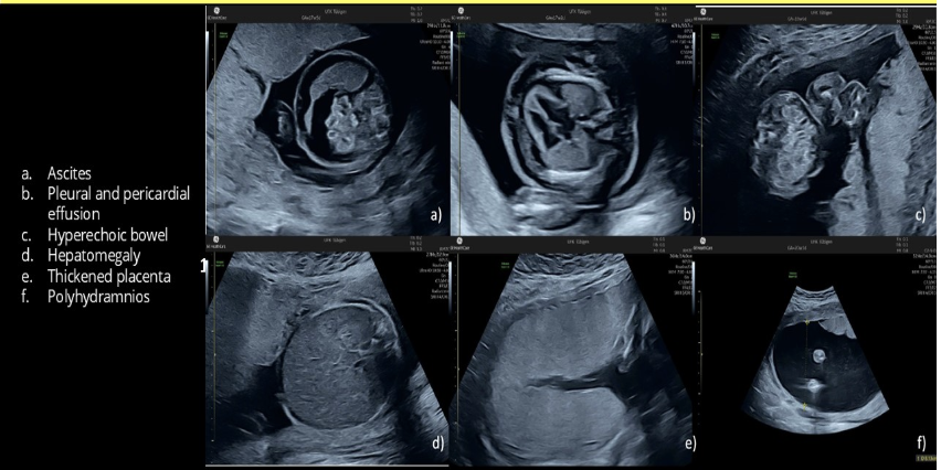 <p>which is most likely to cause <strong>polyhydramnios</strong>, fetal <strong>ascites</strong>, and <strong>hepatomegaly</strong></p><p><strong>.</strong></p><p>a) parvovirus infection</p><p>b) IUGR</p><p>c) potter syndrome</p><p>d) autosomal recessive PKD</p>