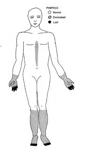 Loss of sensation involves all modalities; loss most severe distally at feet and hands