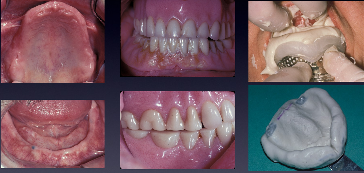 <p>Examination and proper diagnosis; preliminary impressions using alginate and stock trays</p>