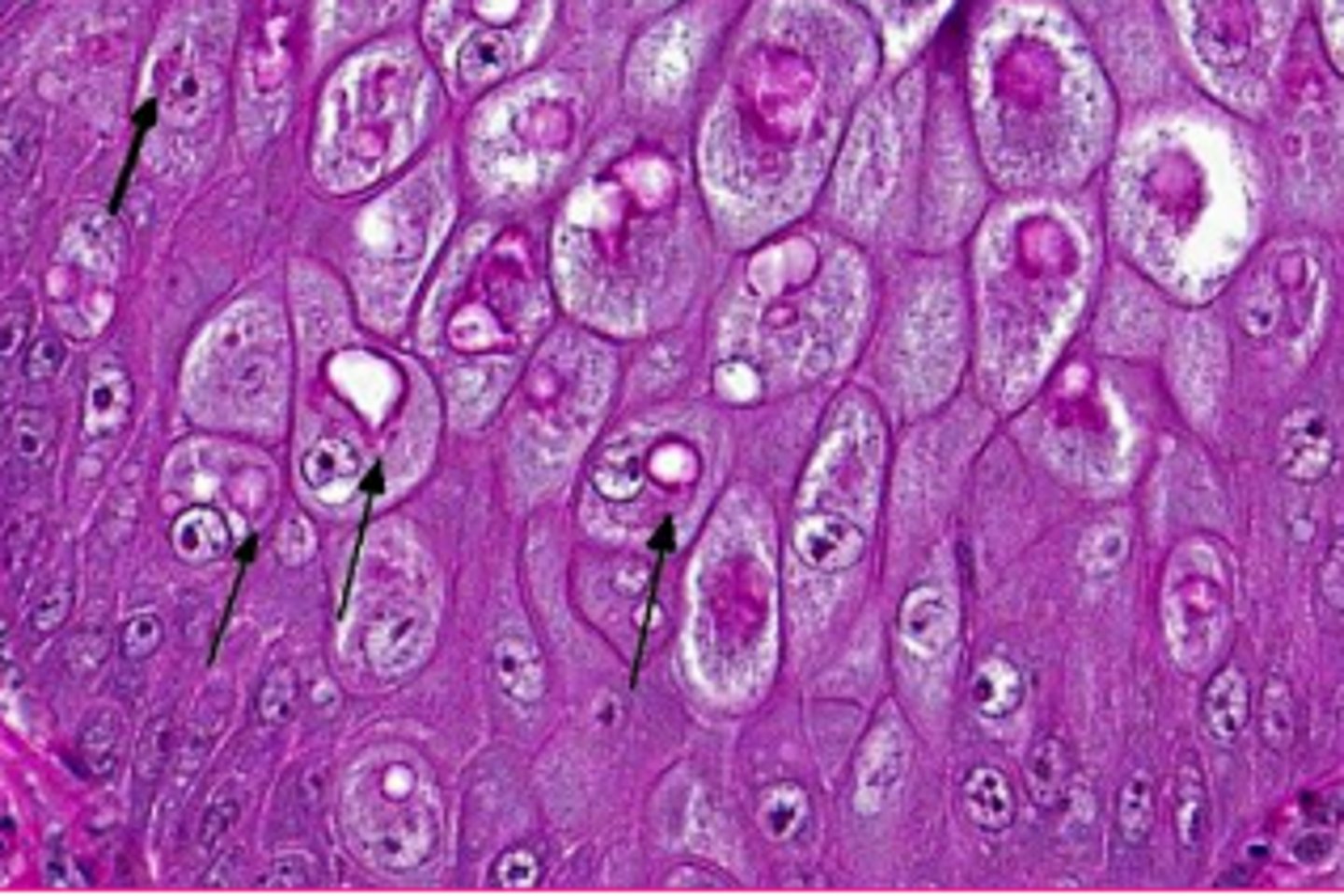 <p>viral inclusions</p>