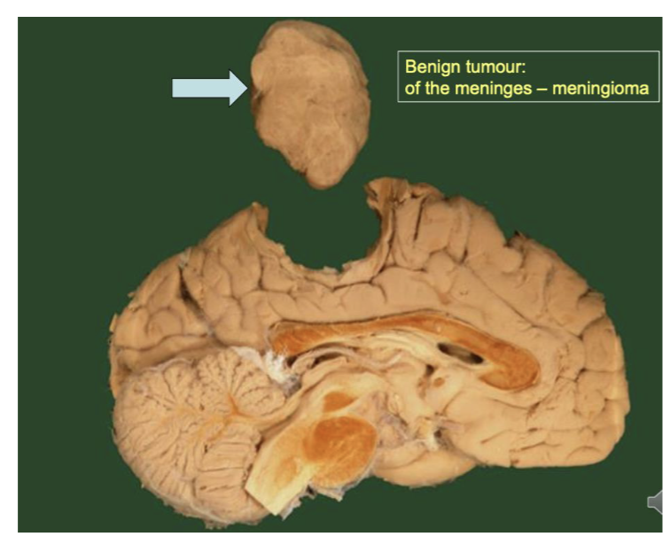 <p>Benign tumor</p><ul><li><p>Confined to original site of the body</p></li><li><p>Clearly defined and intact boundaries</p></li><li><p>Often physically separated from surrounding tissue by a capsule of connective tissue</p></li><li><p>Cells often resemble the apperance of normal cells</p></li></ul><p></p>