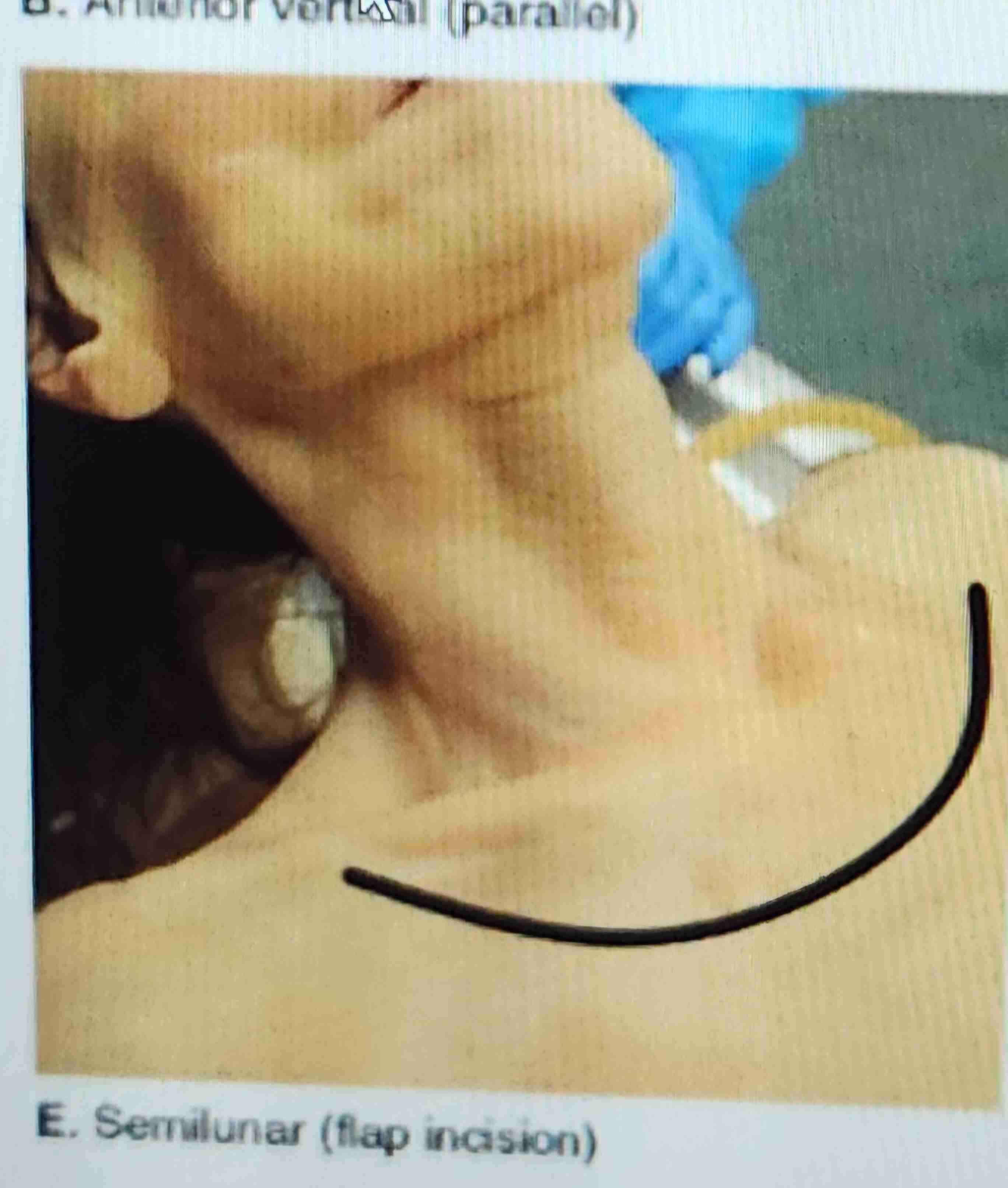 <p>Flap incision (semilunar)</p>
