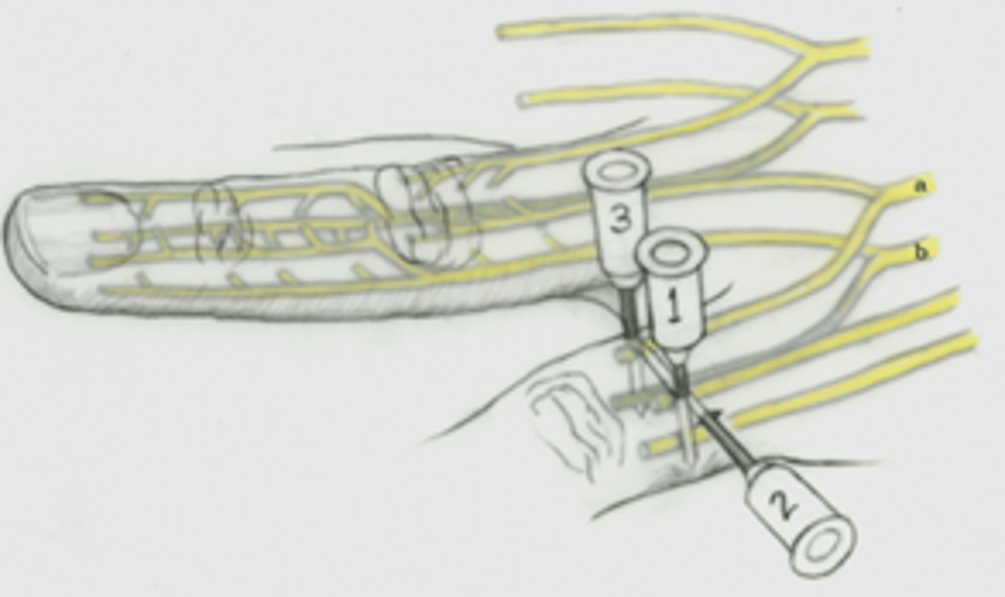 <p>Direct needle across dorsum of digit </p><p>- typically only done for thumb or great toe</p>