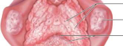<p>Lingual tonsils</p>