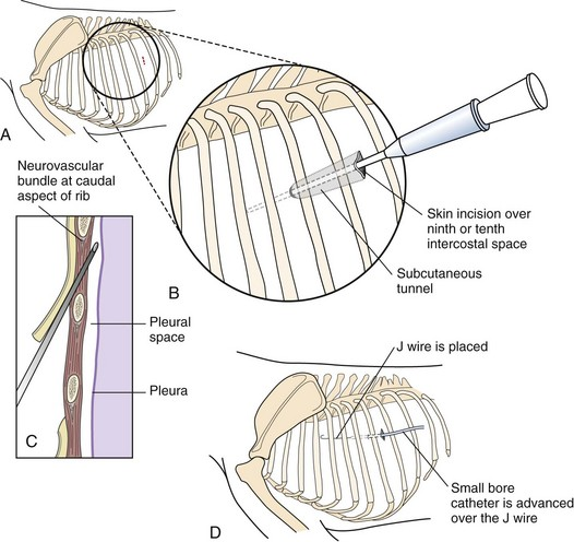<ol><li><p>Intercostal nerve blocks at 7th-9th ICS</p></li><li><p>Skin incision in 9th/10th ICS</p></li><li><p>Make subcutaneous tunnel from 10th to 8th ICS, inserting tube through 8th ICS towards opposite shoulder</p></li><li><p>Suture drain to skin with Chinese finger trap</p></li></ol><p></p>