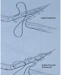 <p><strong>Surgical sutures: </strong>medical devices used to bring body tissues together after injury/surgical procedure. Involves typ. a needle with attached thread. .</p><p><strong>Ideal Suture is: </strong></p><ul><li><p>Easy to handle</p></li><li><p>Minimal tissue reaction (no irritation)</p></li><li><p>Inhibits bacterial growth</p></li><li><p>Holds securely in tissue</p></li><li><p>Non-capillary</p></li><li><p>Non-allergic</p></li><li><p>Non-cardiogenic</p></li><li><p>Non-ferromagnetic</p></li></ul><p><span style="color: blue"><strong>Suture Patterns Classification</strong></span></p><ol><li><p class="text-primary-foreground"><strong>By Continuity</strong>:</p><ul><li><p><strong>Interrupted</strong>: stitches are tied individually</p></li><li><p><strong>Continuous</strong></p></li></ul></li><li><p class="text-primary-foreground"><strong>By Tissue Apposition</strong>:</p><ul><li><p><strong>Appositional</strong>: tissue edges neatly together.</p></li><li><p><strong>Everting</strong>: tissue edges outwards.</p></li><li><p><strong>Inverting</strong>: tissue edges inwards.</p></li></ul></li><li><p class="text-primary-foreground"><strong>By Primary Tissue Application</strong>:</p><ul><li><p><strong>Subcutaneous or Subcuticular</strong>: patterns placed beneath the skin surface to eliminate “dead space” + give some initial apposition of the skin layers, reducing tension.</p></li></ul></li></ol><p><span style="color: blue"><strong>Suture Patterns for Different Procedures</strong></span></p><ul><li><p><strong>Skin closure</strong>:</p><ul><li><p><strong>Appositional</strong>: Simple interrupted, simple continuous, Ford-interlocking.</p></li><li><p><strong>Tension relief</strong>: Horizontal mattress, vertical mattress, near and far patterns.</p></li></ul></li><li><p><strong>Subcutaneous closure</strong>: Interrupted intradermal, simple interrupted, simple continuous, continuous intradermal, horizontal mattress, near and far patterns.</p></li><li><p><strong>Fascia, Linea Alba</strong>: Simple interrupted, simple continuous, Lambert, horizontal mattress, near and far patterns.</p></li></ul><p><span style="color: #008cf9"><strong>Interrupted Suture Patterns (each stitch is independent)</strong></span></p><ul><li><p><strong>Simple Interrupted</strong>:</p><ul><li><p>Placed 2-3 mm from the skin edge.</p></li><li><p>Quick to place, but the overall time for a long incision might be greater due to individual tying. </p></li></ul></li><li><p><strong>Horizontal Mattress</strong>:</p><ul><li><p>Used where tension is present. Can be placed quickly. Can be modified into a cruciate (or "cross-over") suture.</p></li><li><p>Tends to cause tissue eversion (turning outwards), so careful apposition is needed.</p></li></ul></li><li><p><strong>Vertical Mattress</strong>:</p><ul><li><p>Stronger than horizontal mattress in areas of tension. Time-consuming application.</p></li><li><p><strong>Pros</strong>: Less eversion of the skin edges</p></li><li><p>When two vertical mattress sutures are placed parallel before being tied, it forms a "Halsted suture."</p></li></ul></li></ul><img src="https://knowt-user-attachments.s3.amazonaws.com/a8f3cc82-5739-4043-be09-1ccd2f23ab44.png" data-width="50%" data-align="center"><p><span style="color: #0d90e1"><strong>Continuous Suture Patterns (single strand through entire)</strong></span></p><ul><li><p><strong>Simple Continuous</strong>:</p><ul><li><p><strong>Pros: </strong>Provides maximum tissue apposition, relatively airtight, fluid-tight with series of simple interrupted sutures, to close linea alba + subcutaneous tissues. </p></li><li><p>If the suture material is tightened too much, it can create a "purse-string" effect, potentially causing tissue strangulation. Care must be taken.</p></li></ul></li><li><p><strong>Ford Interlocking</strong>:</p><ul><li><p>A modification of the simple continuous pattern, where each loop of suture passes under the previous loop.</p></li><li><p><strong>Pros</strong>: Placed quickly, offers better apposition.</p></li><li><p><strong>Cons</strong>: Can be more difficult to remove than other patterns.</p></li></ul></li></ul><img src="https://knowt-user-attachments.s3.amazonaws.com/636941ce-a8f2-4b95-94d4-abced212c4ac.png" data-width="50%" data-align="center"><p></p>
