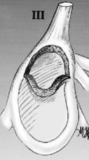<p>Type III SLAP lesion</p>