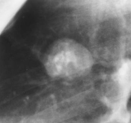 <p>benign or malignant </p>