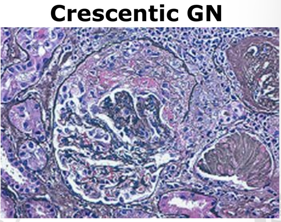 <p><strong>Crescent formation</strong> in Bowman’s space</p>