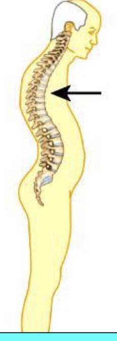 <p>What type of abnormal curve is this?</p>