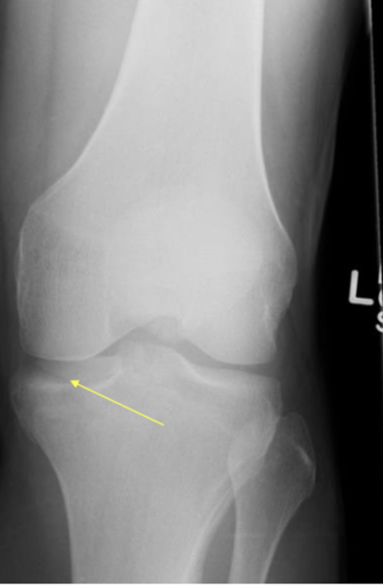 <p>lipohemoarthrosis with intraarticular fractures</p>