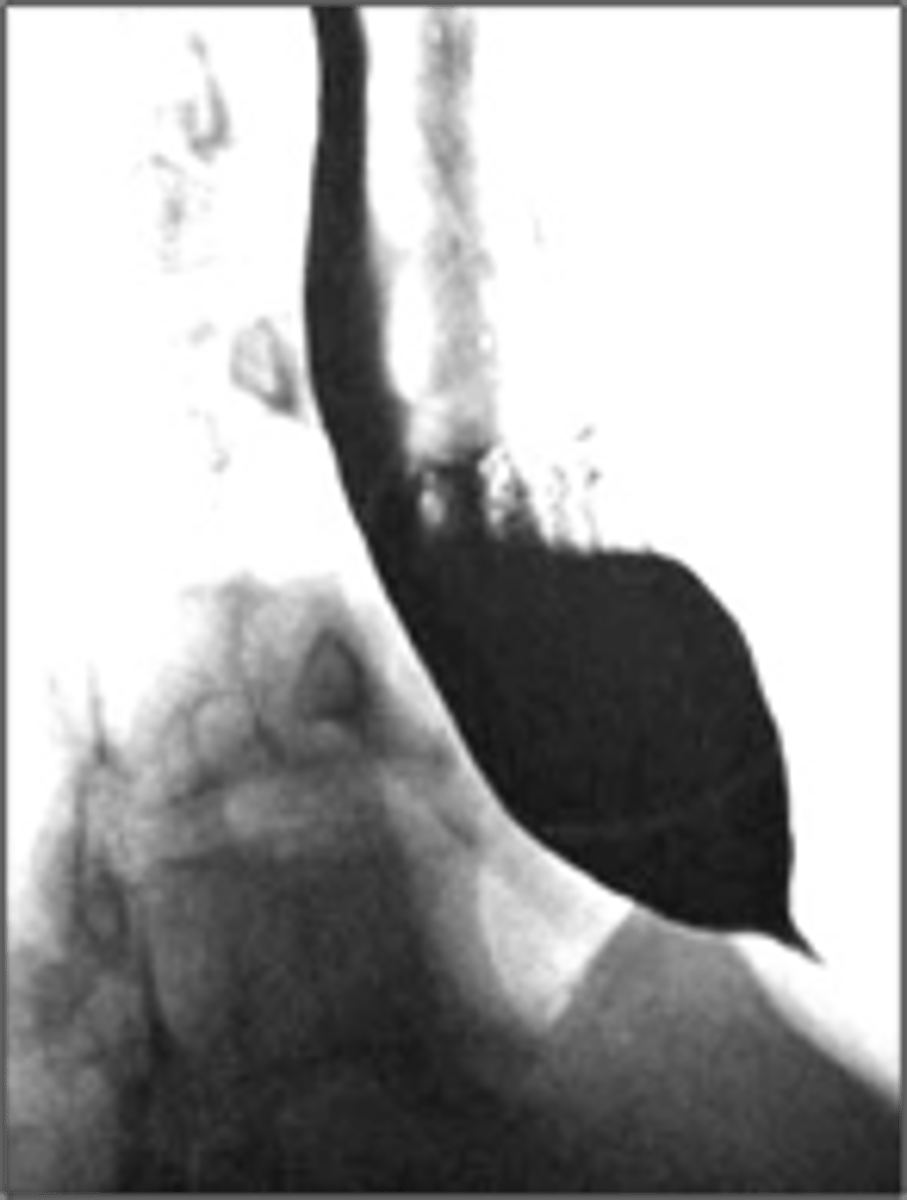 <p>What has the following characteristics?</p><p>• Motility disorder</p><p>• Dysphagia to solids and liquids</p><p>• Absent ganglion cells</p><p>• Distal stricture “birds beak” on barium</p>