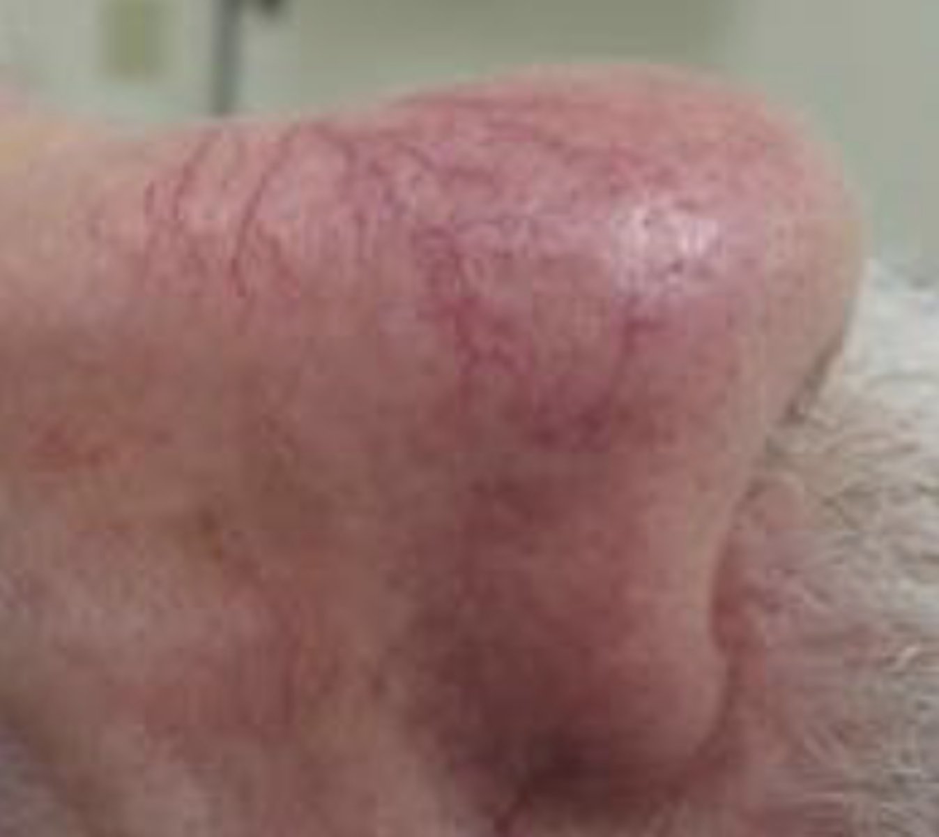 <p>An area of prominent blood vessels</p>