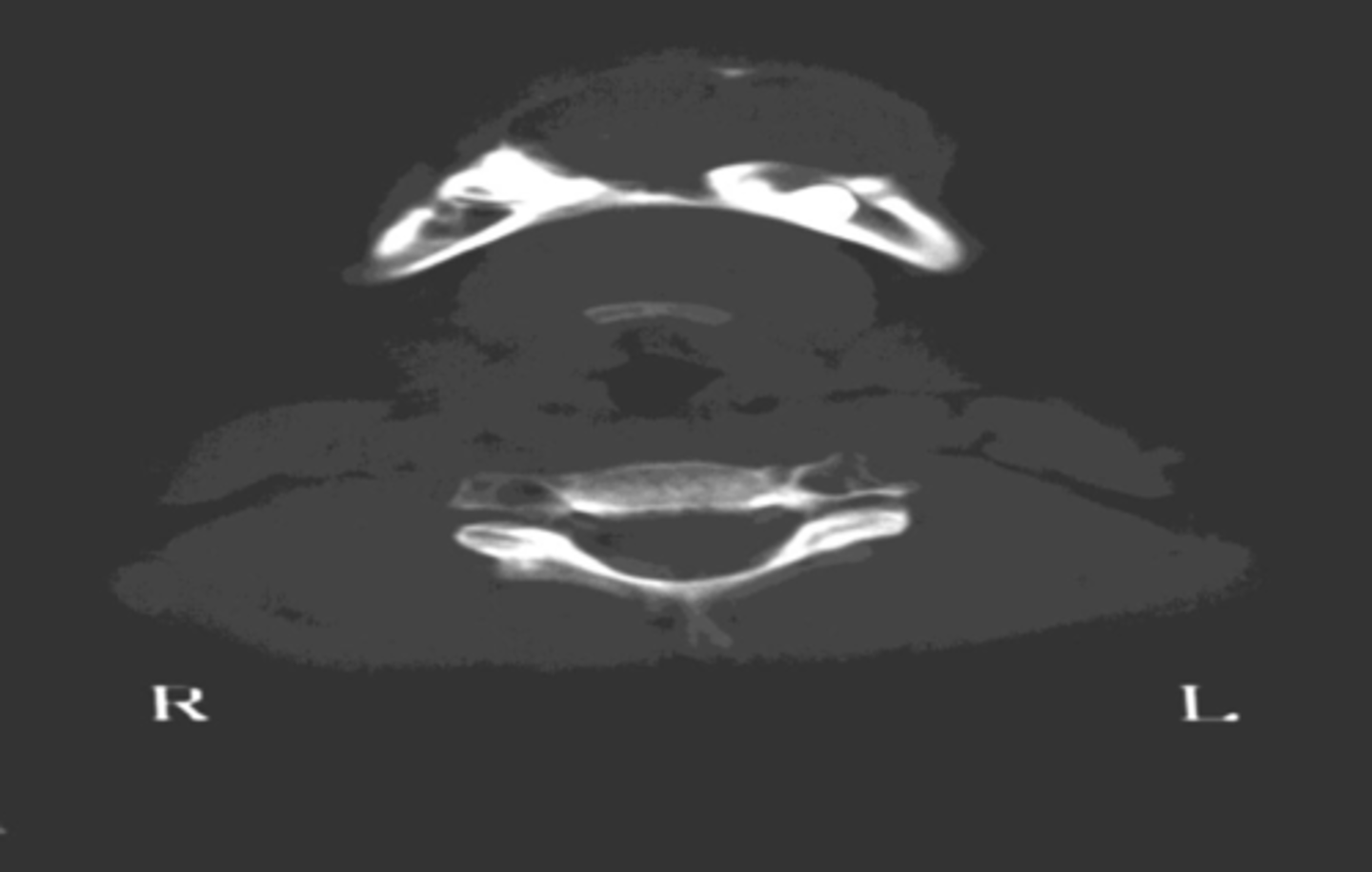 <p>This 12-year-old female presented to your office with a painless enlargement of her anterior mandible. Computed tomography was utilized to obtain images.</p><p>How would you go about doing this?</p>