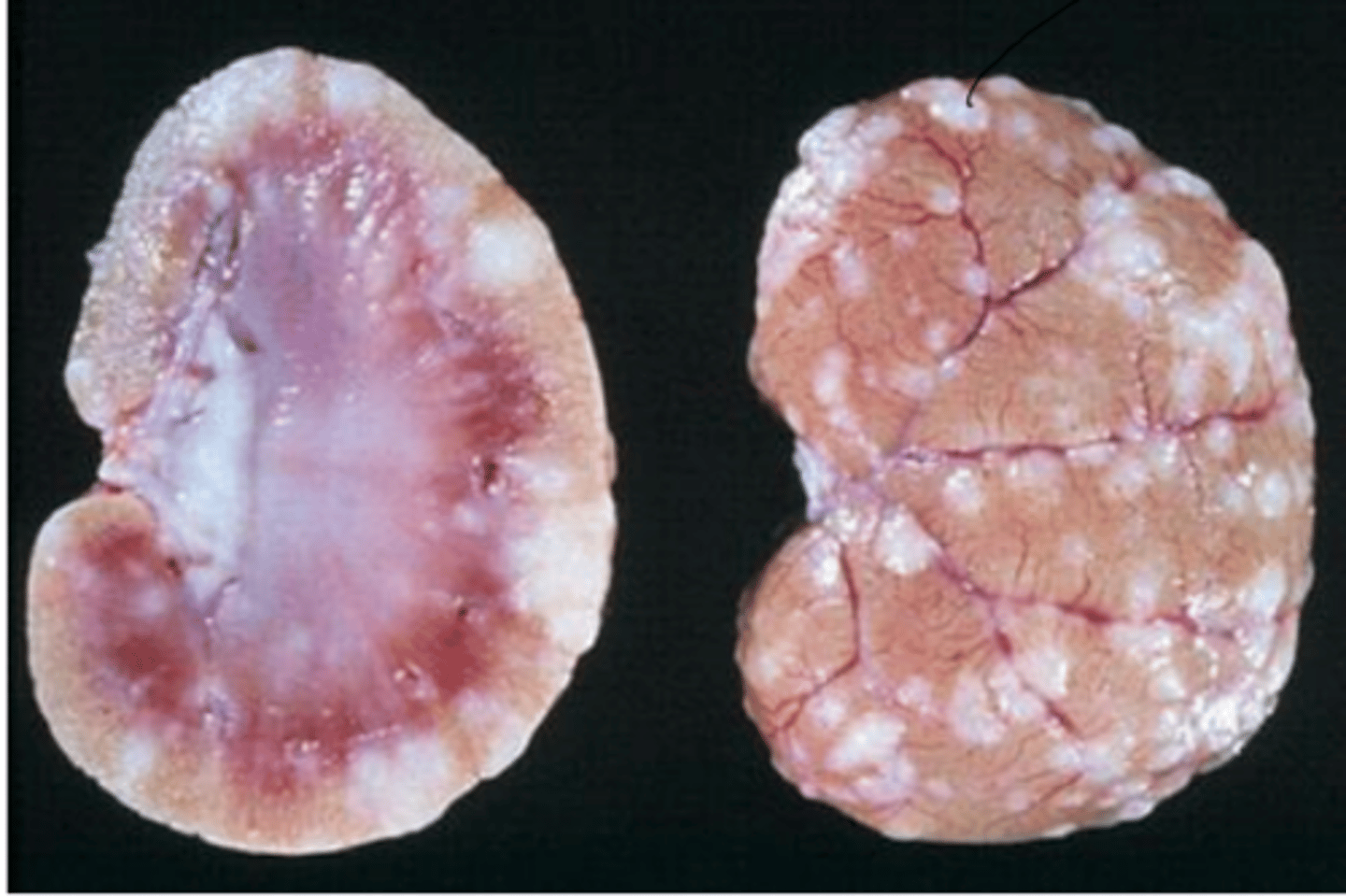 <p>what type of exudate is being depicted in the image?</p>