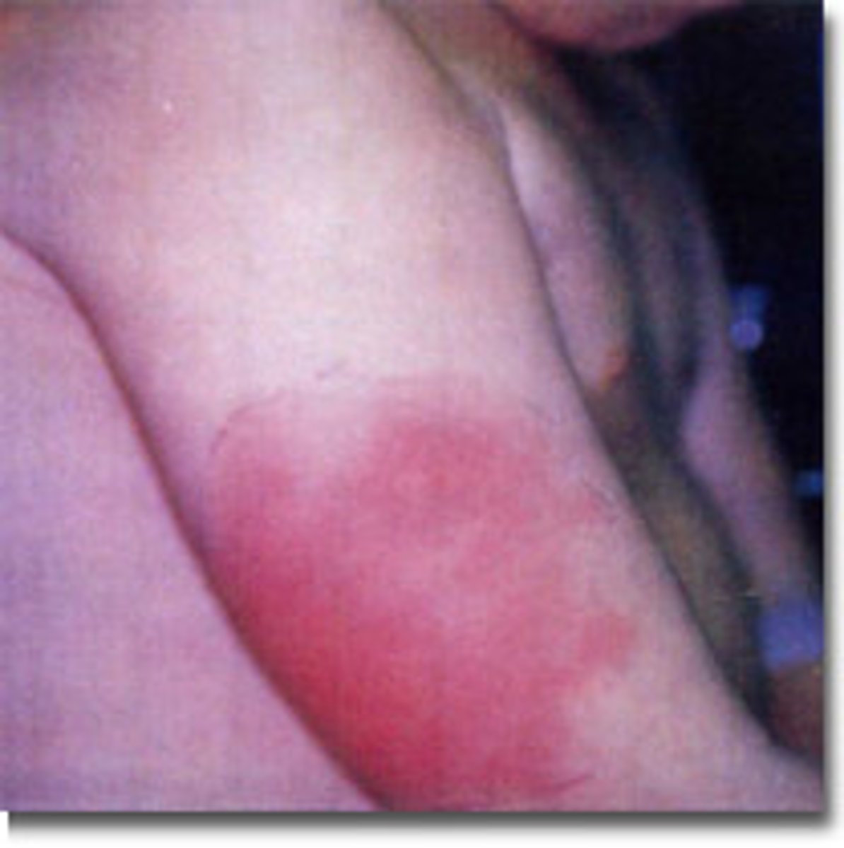 <p>Local reaction seen in the skin after subcutaneous injection of an Antigen that has already generated IgG antibodies</p><p>- Inflammation</p><p>- Large, diffuse Erythema and Edema</p>