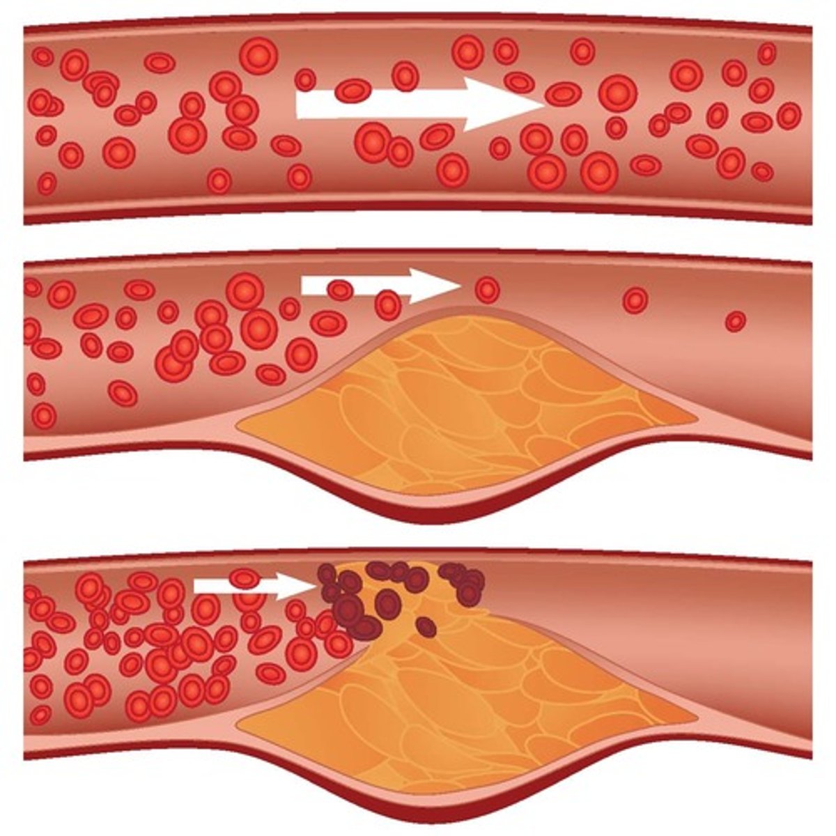 <p>Deposits of cholesterol and fats in the arteries --&gt; platelets stick to them --&gt; clot forms</p>