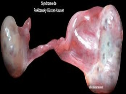 <p>CASE: A 24-year-old married female visited an OB-GYN Clinic with a chief complaint of no history of menstrual onset since adolescences. Additionally, during history-taking, the patient and husband of the patient complained of a short blind-ended vaginal vault of the index patient during trials of sexual intercourse. After a series of imagings and laboratory workups, patient was diagnosed with “Mayer-Rokitansky-Küster-Hauser (MRKH) Syndrome” or a congenital case of a biologically female patient without internal genitalia (Meaning: NO Fallopian Tubes; NO Uterus; NO Cervix of the uterus; with Absence of Upper 3rd of the Vagina leading to a shorter vaginal canal externally). (Check picture below: Presence of 2 functional ovaries held by a common ligament of the ovary proper with complete absence of intervening female internal genitalia.</p><p>This MRKH syndromic disorder is due to congenital absences of these embryonic structures in a female’s body:</p><p>A. Wolffian ducts</p><p>B. Müllerian ducts</p><p>C. Indifferent Gonads</p><p>D. Cloacal folds</p>