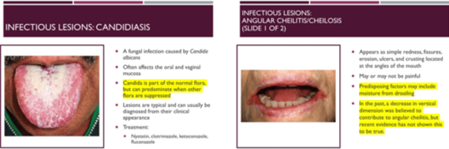 <p>The first statement is true, the second is false.</p><p>TRUE-</p><p>Candida is part of the normal flora, but can predominate when other flora are suppressed</p><p>FALSE -</p><p>Infectious Lesions: Angular Cheilitis/Cheilosis</p><p>>> In the past, a decrease in vertical dimension was believed to contribute to angular cheilitis, but recent evidence has not shown this to be true.</p>