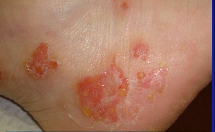 <p><span>Weeping vesicles on erythematous plaques of acute <strong>[...]</strong>&nbsp;</span></p>